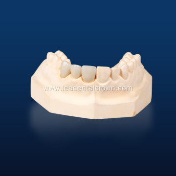 Porcelain-Fused Zirconia Veneers for Dental Restoration